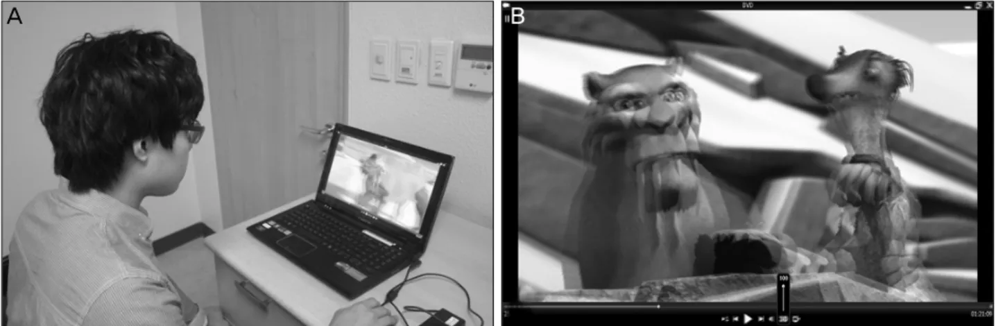 Figure 1. (A) The patient watches the 3D image displayed by 3D laptop computer. (B) Animation is converted into 3D image by  TriDef 3D media player
