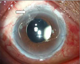 Figure 6. After 6 months later from operation day, reinserted  anterior chamber intraocular lens (ACL) in situ at 2-8 o’clock axis