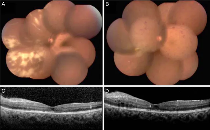 Figure 1. Fundus photographs &amp; OCT of both eyes in case 1. (A) Fundus photograph of the left eye shows opaque white le- le-sions at the inferonasal retina