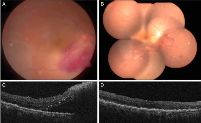 Figure 2. Fundus photographs &amp; OCT of both eyes in case 2. (A) Fundus photograph of right eye shows retinal hemorrhage  with opaque white lesions in inferior region of the optic disc and atrophic lesions at the temporal region
