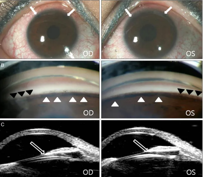 Figure 1. Automated visual field examination before ICL im- im-plantation shows no glaucomatous visual field defects in both eyes.