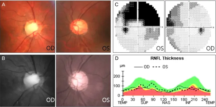 Figure 3. (A) Disc photograph shows vertical cup-disc ratio of 0.75 in the right eye and 0.8 in the left eye consistent with glaucoma- glaucoma-tous optic disc change