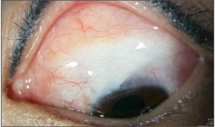 Figure 4. Slit lamp photography of the left eye shows a well  elevated bleb of medium height, 4 clock hour horizontal  ex-tent, and mild vascularity 6 month after trabeculectomy with  mitomycin C.