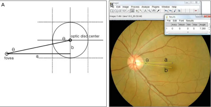Figure 1. (A) The measurement of disc foveal distance and angle. ‘a’ is horizontal optic disc center-foveal distance
