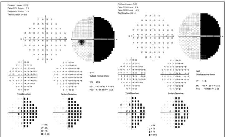Figure 2. Visual field as determined by Humphrey automated perimetry. The visual field test demonstrates a right sided homon- homon-ymous hemianopia