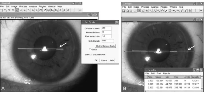 Figure 1. Setting scale (pixels/mm) with 8 mm guide line (white arrow) (A). Calculating horizontal W TW  (white arrow) by image  analysis program (Image J 1.44p) (B).