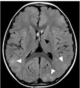 Figure 1. Axial T2-weighted images of MR show that sub- sub-ependymal nodule (black arrow head) projecting into lumen of  left lateral ventricle and multiple subtle bilateral cortical and  subcortical tubers (white arrow heads)