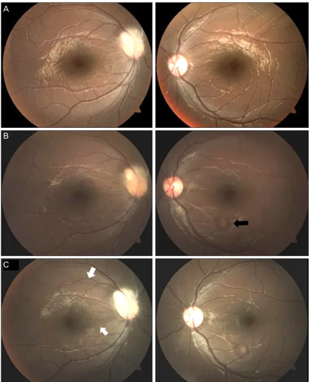 Figure 2. Development of nerve fiber layer defect associated with astrocytic hamartoma in a patient with tuberous  sclerosis