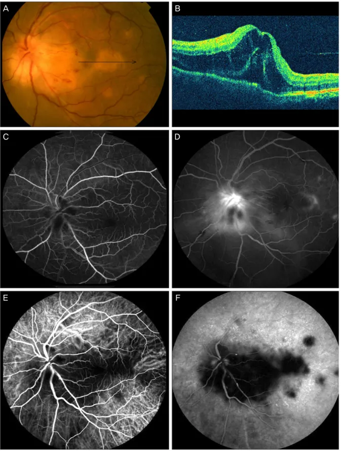 Figure 1. (A) Fundus photograph at the initial visit shows severe optic disc swelling and multiple yellowish chorioretinal  lesions
