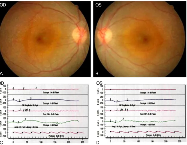 Figure 1. (A, B) Fundus photographs show diffuse retinal degeneration with sparing of the macula in both eyes