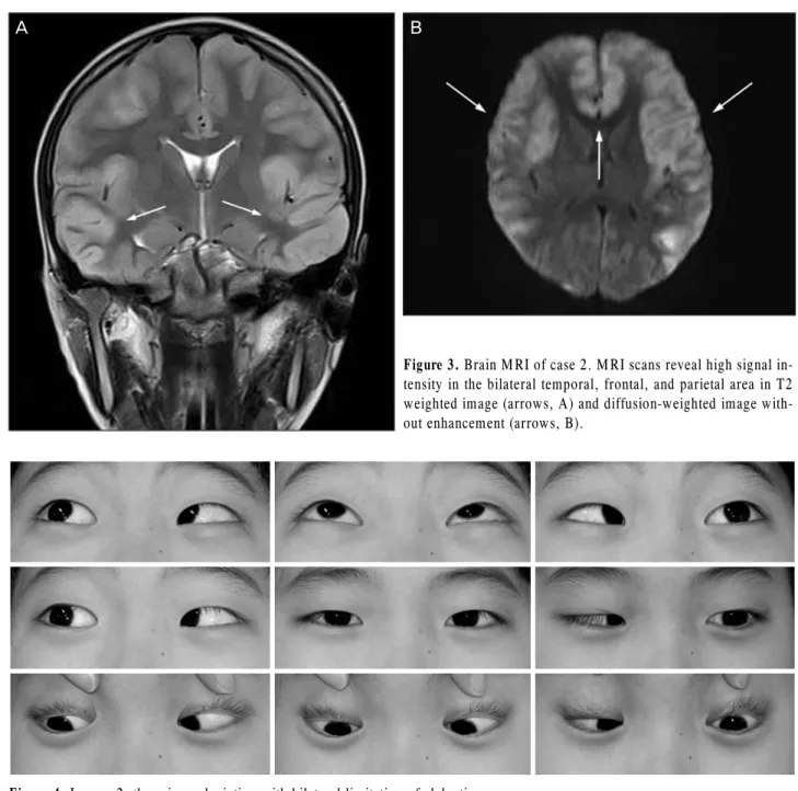 Figure 4. In case 2, there is esodeviation with bilateral limitation of abduction.