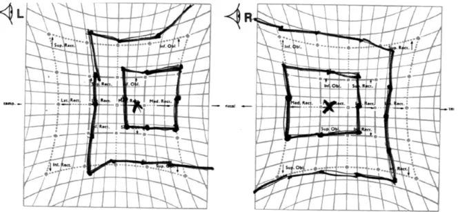 Figure 5. Hess screen test revealed esotropia with bilateral abduction limitation in case 2