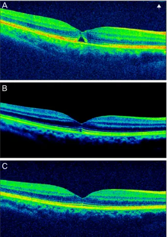 Figure 3. Optical coherence tomography (M-OCT) of idiopathic stage 2 eccentric macular hole (MH) (case 5)