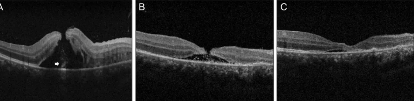 Figure 4. Optical coherence tomography (M-OCT) of traumatic macular hole (MH) (case 6)