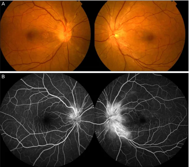 Table 1. (Case 1) Longitudinal changes of the average retinal  nerve fiber layer (RNFL) thickness after intravitreal  bev-acizumab (IVB) injection