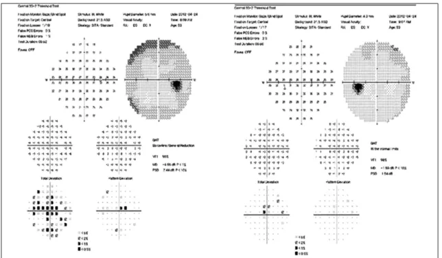 Figure 2. Visual field (VF) showing central scotoma in the right eye.