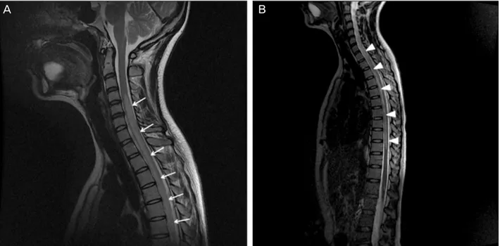 Figure 3. T2-weighted sequences of spinal cord MR. (A) The picture shows high signal lesion in cord of C2 and C3 level and more  extensive lesion in cord of C-spine below C4 and upper T-spine level (arrows)