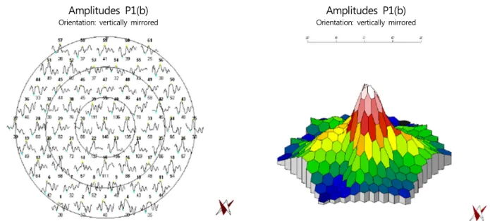 Figure 3. Multifocal Electroretinography (Mf-ERG). Neither the trace array nor three-dimensional response density plot demon- demon-strates any retinal dysfunction corresponding to the region of field defect