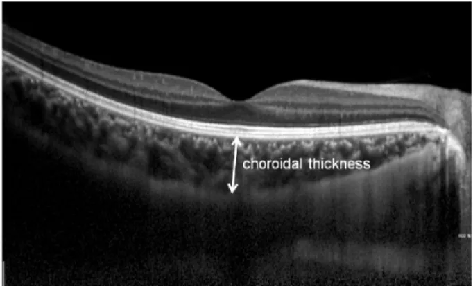 Figure 1. The choroid is seen in cross-section using EDI-  OCT. Subfoveal choroidal thickness was measured vertically  from the outer border of the retinal pigment epithelium to the  inner border of the sclera.