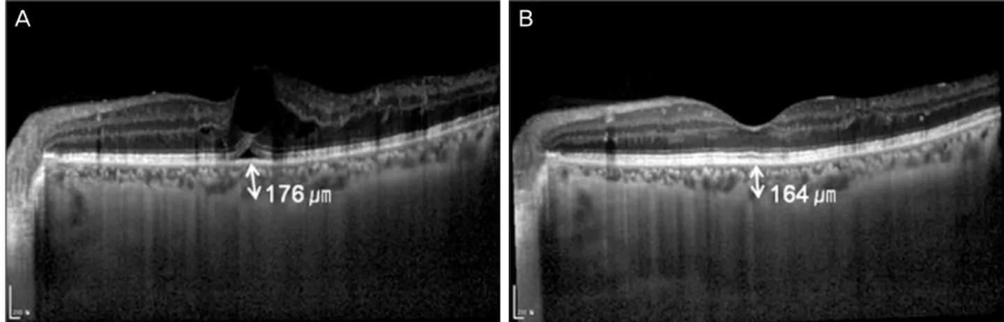 Figure 3. Representative case of a 51-year-old man with diabetic macular edema was treated with IVB
