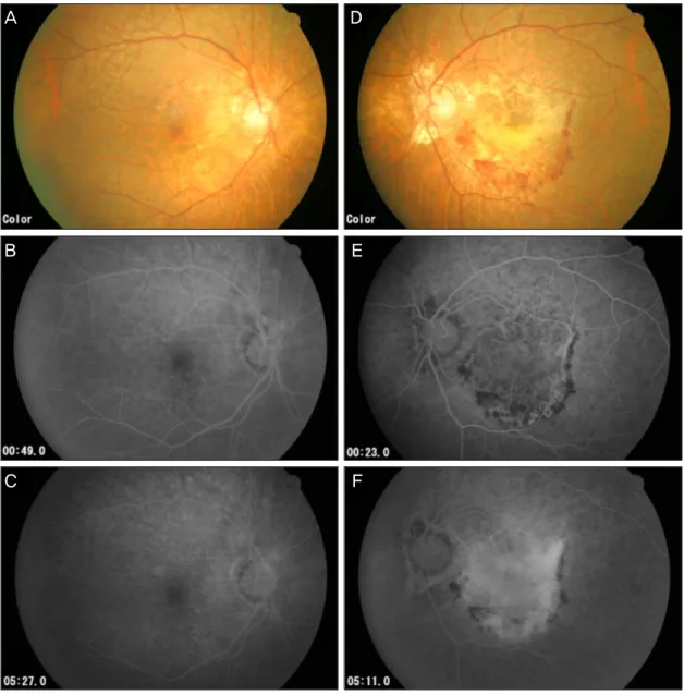 Figure 2. Fundus photograph and fluorescein angiograph of the right eye of a 64 year old female (A, B, C); left eye  (D, E, F)