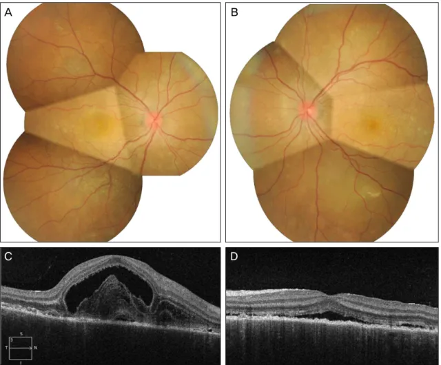 Figure 1. Fundus photographs and optical coherence tomography of patient at presentation (A, C: right eye; B, D: left eye).