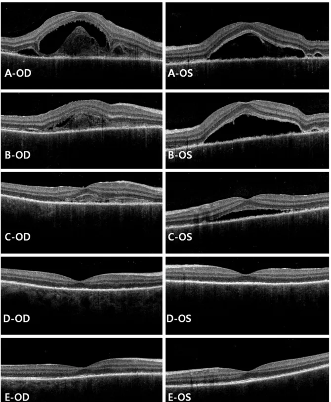 Figure 2. Serial optical coherence tomography (OCT) during follow-up period. (A) Before intravitreal triamcinolone in- in-jection and using corticosteroid eye drops