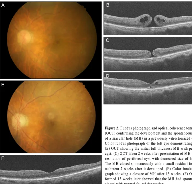 Figure 2. Fundus photograph and optical coherence tomography (OCT) confirming the development and the spontaneous closure of a macular hole (MH) in a previously vitrectomized eye