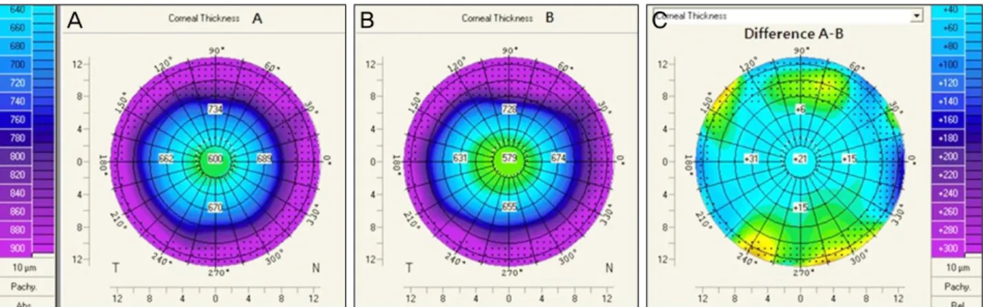 Figure 1. Distribution of age at time of pterygium operation by  decade.