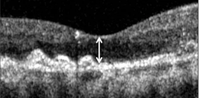 Figure 1. Central foveal thickness (double-head arrow) was  defined as the vertical distance between internal limiting  mem-brane and retinal pigment epithelium at foveal center based on  optical coherence tomography image centered at the center of  the fo