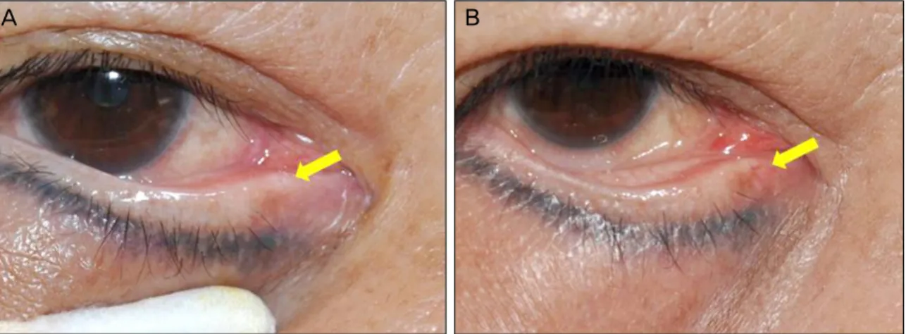 Figure 4. (A) Preoperative stenotic punctum is shown. (B) Postoperative 6 months, dilated punctum was maintained