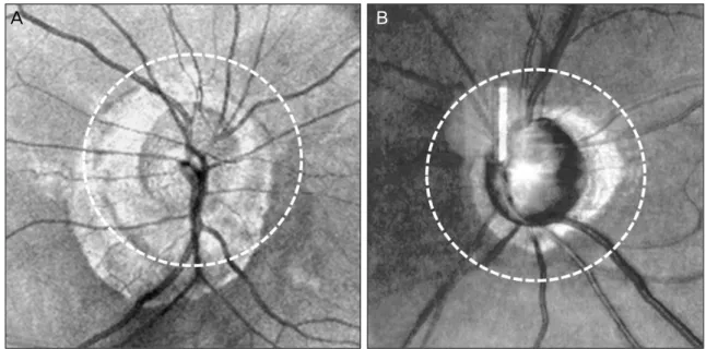 Figure 1. Classification of the subject group by the area of the peripapillary atrophy in relation to the optic disc scan  circle of Cirrus OCT