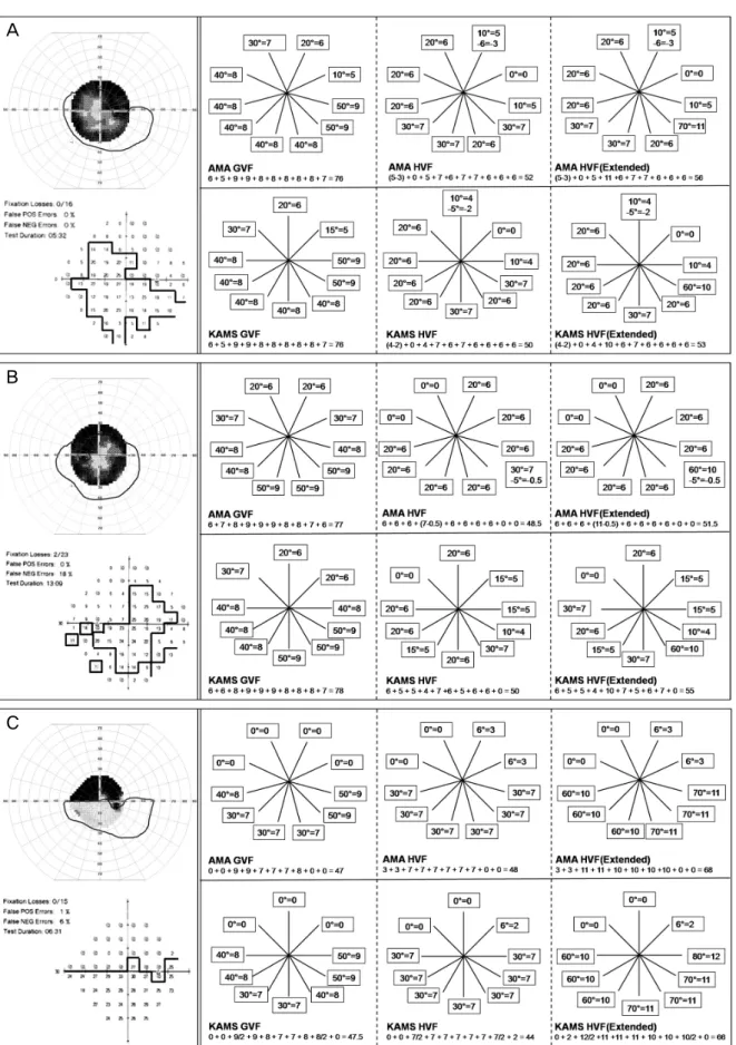 Figure 3. Irregular visual field groups. (A) 68-year-old, male, glaucoma. Humphery VFSs are underestimated than  Goldmann VFS in both guides