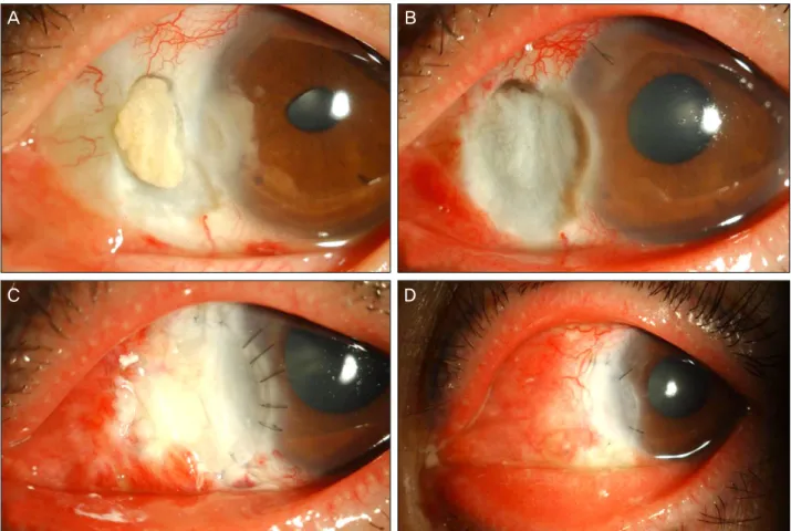 Figure 1. Preoperative and postoperative appearances of case 1. (A) Preoperatively, melted sclera and corneal ulcer with feath- feath-ery-like fungal invasion are noted