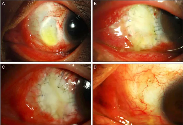 Figure 2. Preoperative and postoperative appearances of case 2. (A) Preoperatively, melted scleral lesions are noted