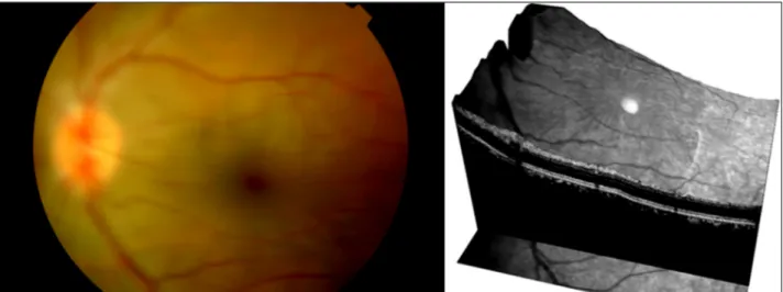 Figure 1. Preoperative fundoscopy and spectral domain optical coherence tomography (SD-OCT) in the three dimensional image  show chorioretinal folds and retinal thickening at macula area.