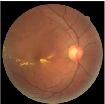 Figure 1. Initial fundus photograph. The right eye shows  branch retinal vein occlusion (BRVO) with macular edema.