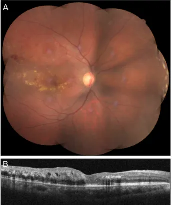 Figure 5. Fundus photograph (A) and optical coherence to- to-mography (B) of the right eye, one month after treatment  shows the macular edema much improved.
