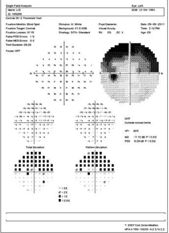 Figure 1. Humphrey visual field test shows arcuate defect at  superior field of the left eye.