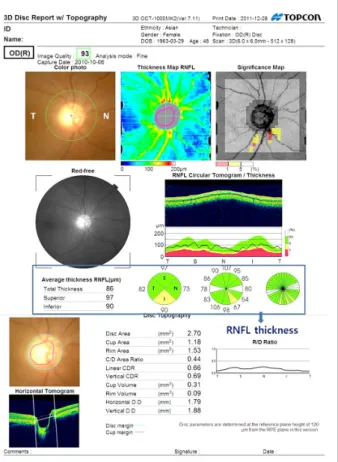 Figure 1. 3D-OCT 1000 analysis report. An optic disc cube  scan protocol was used to measure the RNFL thickness in a 6 