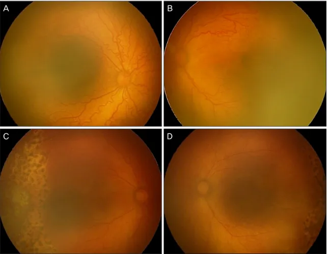 Figure 1. Case 2. Fundus findings at preoperative (A, B) and 12 days after diode laser photocoagulation and intra- intra-vitreal bevacizumab injection (C, D)