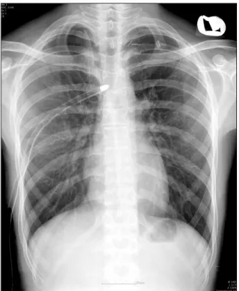 Figure 2. Chest X-ray showing that tip of chest tube is posi- posi-tioned at T5 level in thoracic caivity