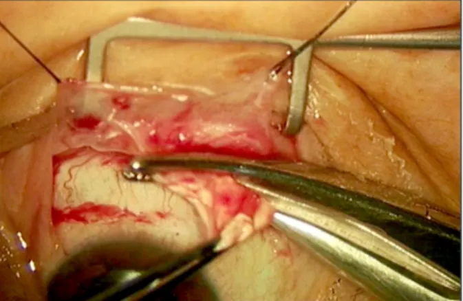 Figure 2. Sub-Tenon triamcinolone acetonide and Tenon’s capsule is removed with forceps and tenotomy scissors after  dissection of the conjunctiva.