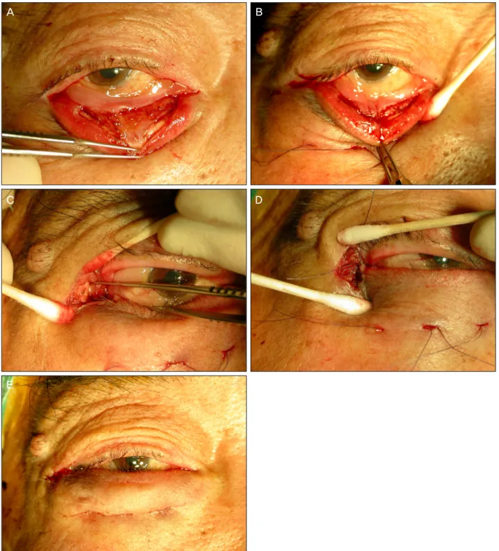Figure 1. Surgical procedures in repairing right lower eyelid involutional ectropion. (A) A diamond-shaped fusiform wedge of the  conjunctiva and lower eyelid retractor was excised inferior to the lower margin of the tarsal plate, depending on the degree o
