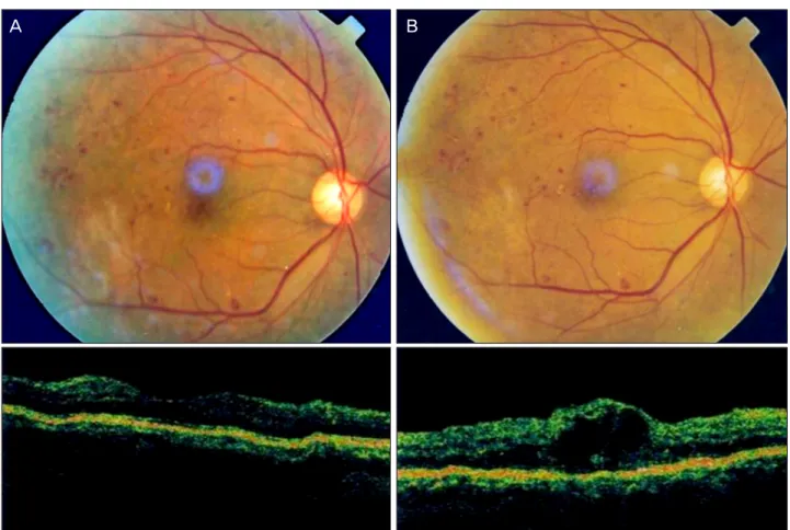 Figure 1. (A) Preoperative fundus photograph shows severe nonproliferative diabetic retinopathy and hard exudates near macula