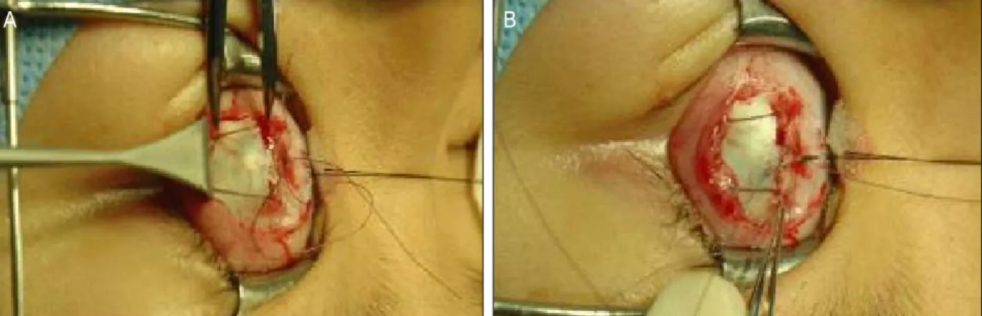 Figure 1. Procedures of adjustable rectus muscle recession. (A) Sutures are passed through the each end of original insertion and  passed through center of original insertion again