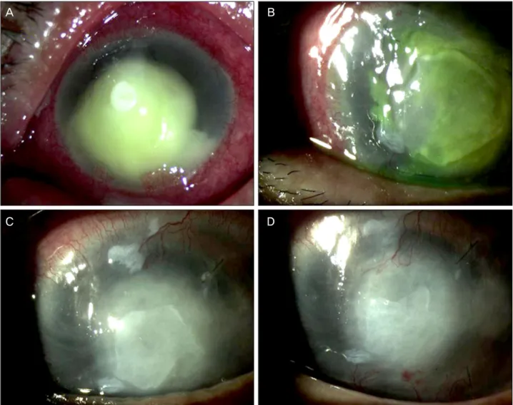 Figure 2. (A) On initial examination, subtotal corneal infectious infiltration with hypopyon and impending corneal perforation was  shown