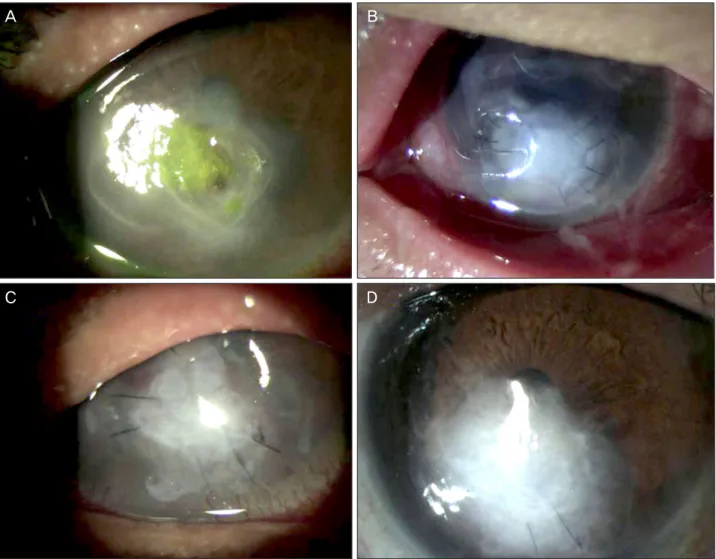 Figure 3. (A) On initial examination, corneal perforation with incarcerated iris and epithelial defects with stromal infiltration was  shown
