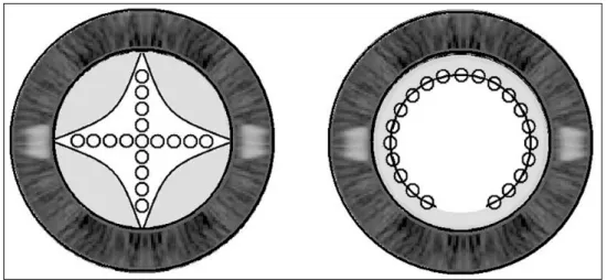 Figure 1. Two different open- open-ing patterns of Nd:YAG laser  posterior capsulotomy.