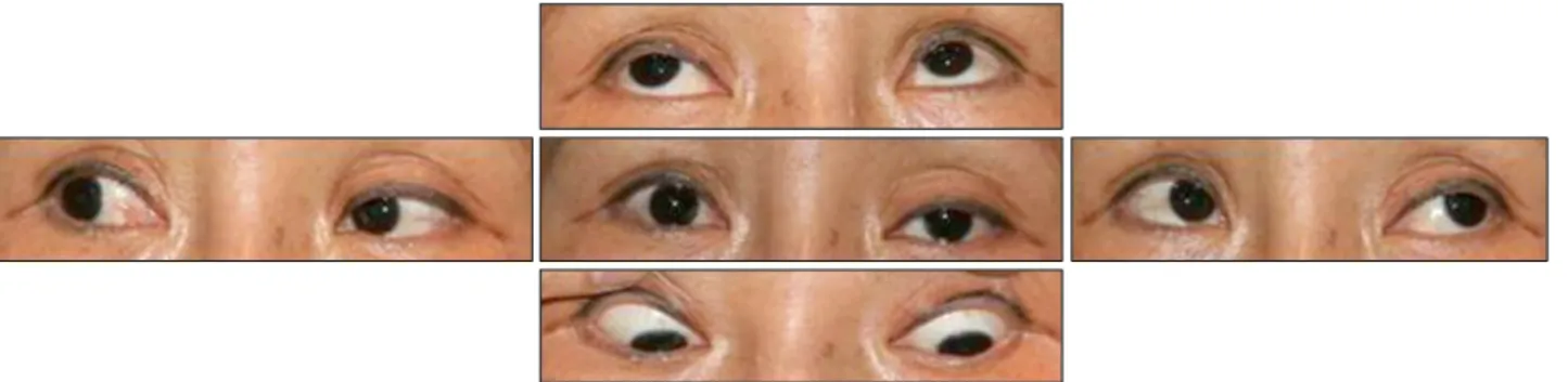 Figure 1. At the initial presentation, left eyelid ptosis is noted, but there was no definite ocular movement limitation.